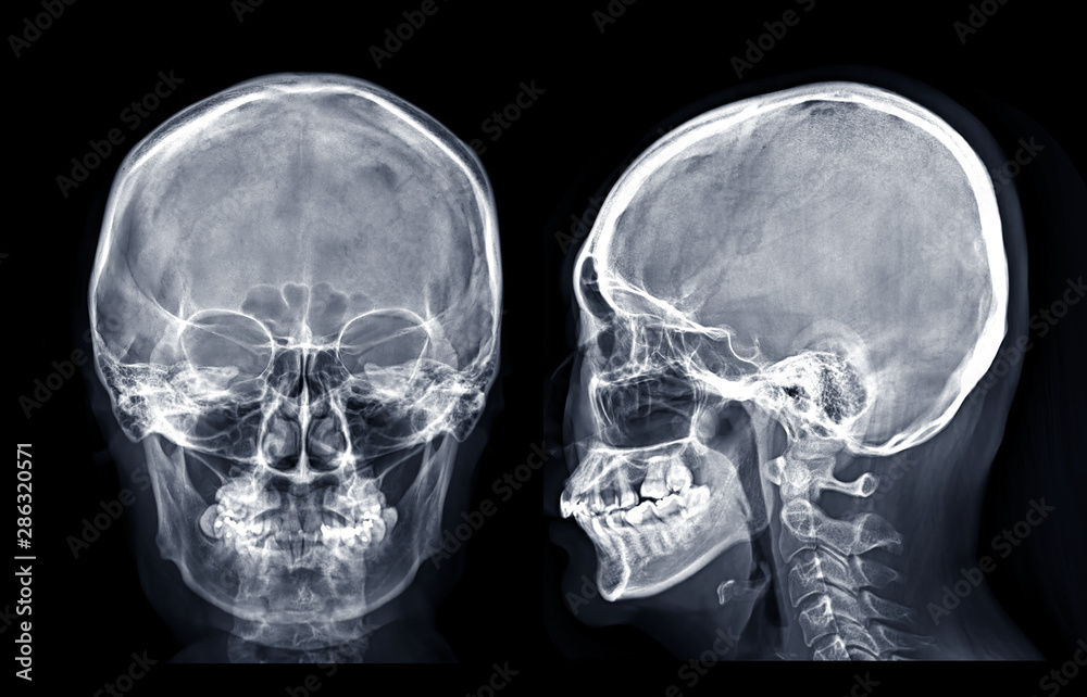 Skull xray image of Human skull AP and Lateral isolated on Black