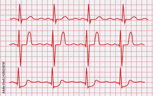 Cardiogram or Pulse Line on a Pink Grid. Vector
