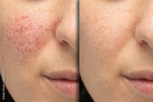 Before and after laser treatment for rosacea photo