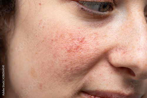 Problems with skin acne and pore on woman's cheek