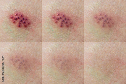 Virus on the body. Rash of Shingles on the skin. Bright red blisters of zoster. Smallpox Disease. A set of photos.