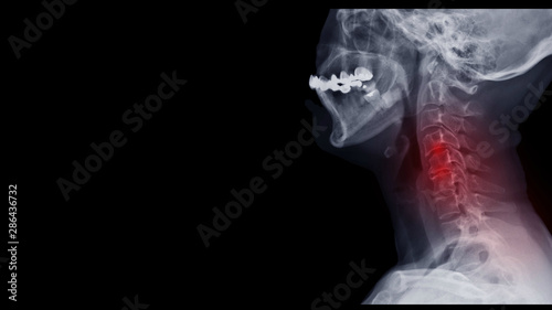 Film x-ray spine radiograph show cervical spondylosis which is spinal disc degenerative disease. The patient is phone addiction and has neck pain, numbness and weakness. Highlight on painful area. 