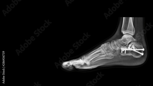 Konstfotografi Film ankle X-ray radiograph showing heel bone broken (calcaneus fracture) which treated by open reduction and internal fixation(ORIF) with plate and screws