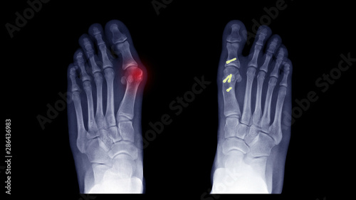 Film x-ray foot radiograph show Hallux valgus deformity or Bunion disease which Right side treatment by surgery with corrective osteotomy. Left side show progressive disease. Medical concept