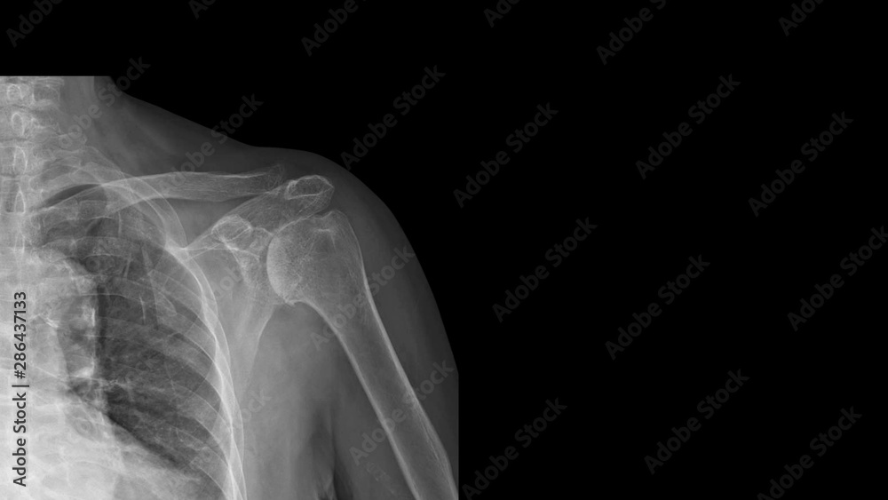 Film Xray shoulder radiograph show degenerative osteoarthritis disease