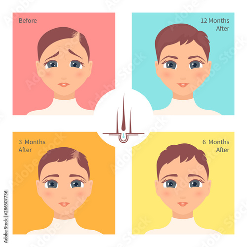 Hair transplantation surgery post operative result infographics. Woman patient before and after procedure. Female hair loss treatment with FUT, FUE method. Alopecia medical vector design for clinics.