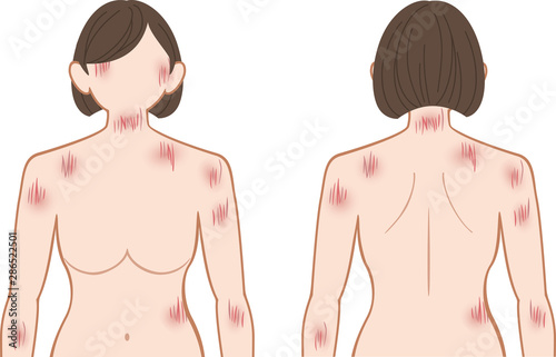 ひっかき傷　上半身　女性