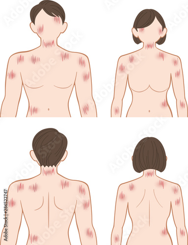 ひっかき傷　上半身　男女セット
