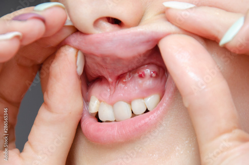 Close-up of gum with cyst or purulent flux. Disease of the gums and teeth.