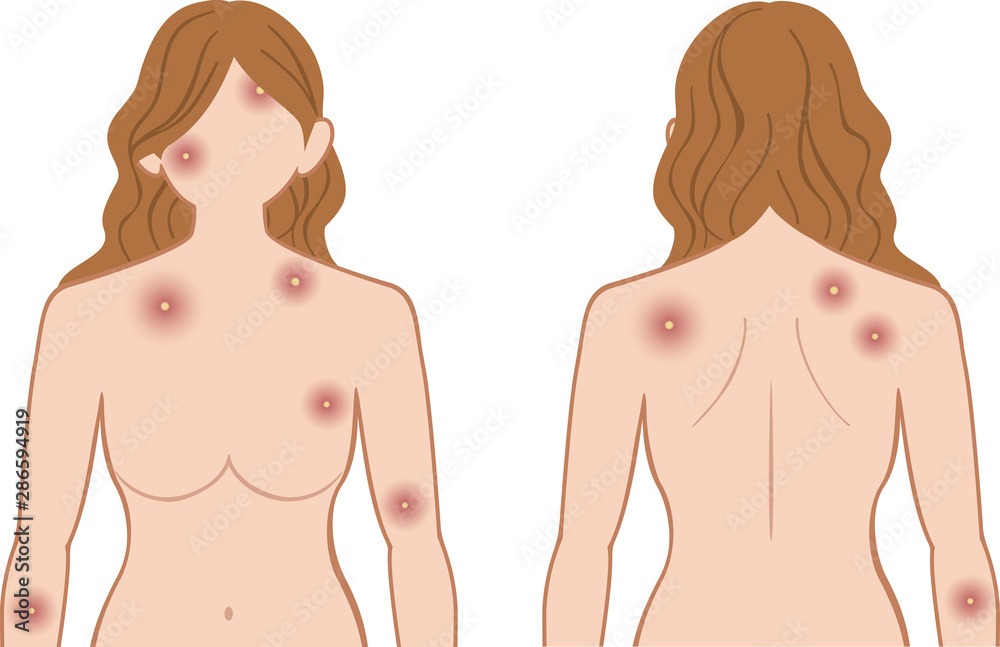 化膿 上半身 女性 化膿 上半身 女性