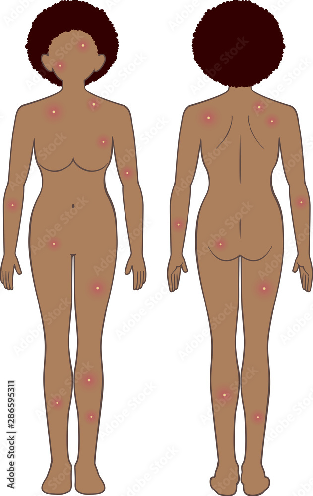 化膿 全身 女性 化膿 全身 女性
