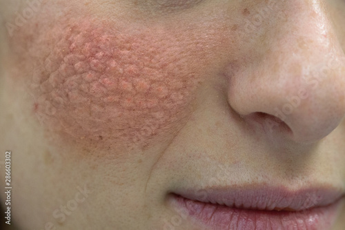 close up of young caucasian women face with red cheeks that cause skin problems photo