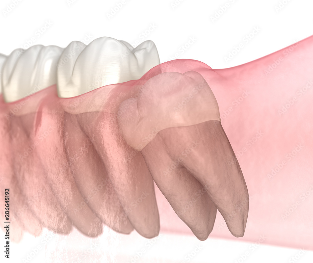 Mesial impaction of Wisdom tooth. Medically accurate tooth 3D ...