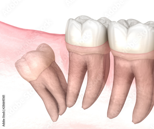 Distal impaction of Wisdom tooth. Medically accurate tooth 3D illustration