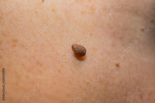 Wallpaper Mural Papilloma on a woman's skin. Macro,soft focus. Torontodigital.ca