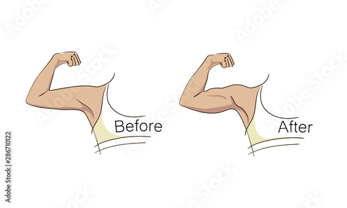 Female biceps and triceps before and after sport. Arms showing progress after fitness. Bent arm with bat wing vs well toned arm. Vector illustration for beauty, cosmetology