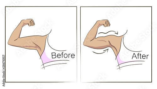 Female biceps and triceps before and after sport. Arms showing progress after fitness. Bent arm with bat wing vs well toned arm. Vector illustration for beauty, sport or medicine infographic.