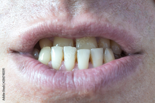 Crooked teeth of a man close-up.