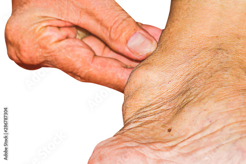 Severe gout in men suffering from joint pain, bone pain, gout, rheumatoid symptoms, radioactive sickness, ill man concept of male osteoporosis, injured bone, injury, pain, arthritis,arm, foot, knee