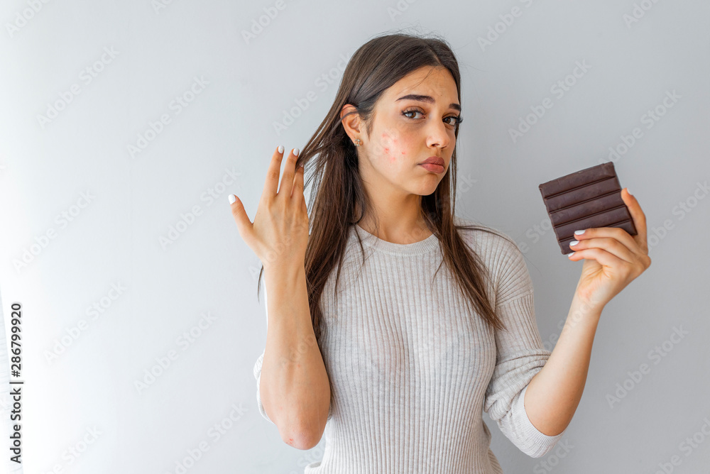 Closeup Acne Problem Face Woman Eating Chocolate bar. Young woman with