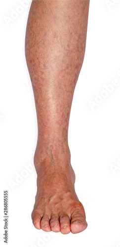 varicose and spider veins leg isolated on white background with clipping path © iploydoy