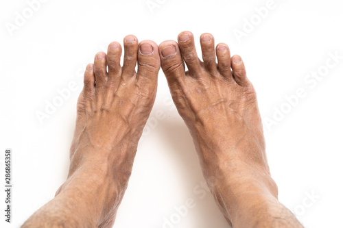 Asian man foot brown and dry skin