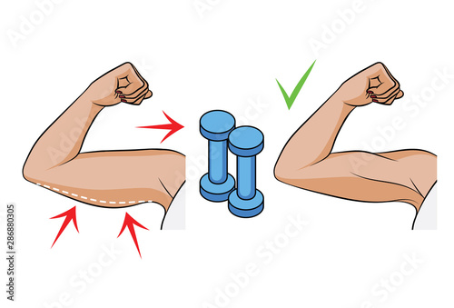 Color vector illustration of a problem of overweight in women. Female hands side view. Body fat on female triceps. Before and after dumbbell exercises