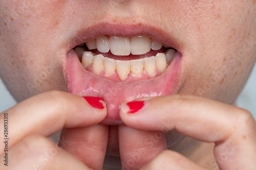 Gum recession after a frenectomy