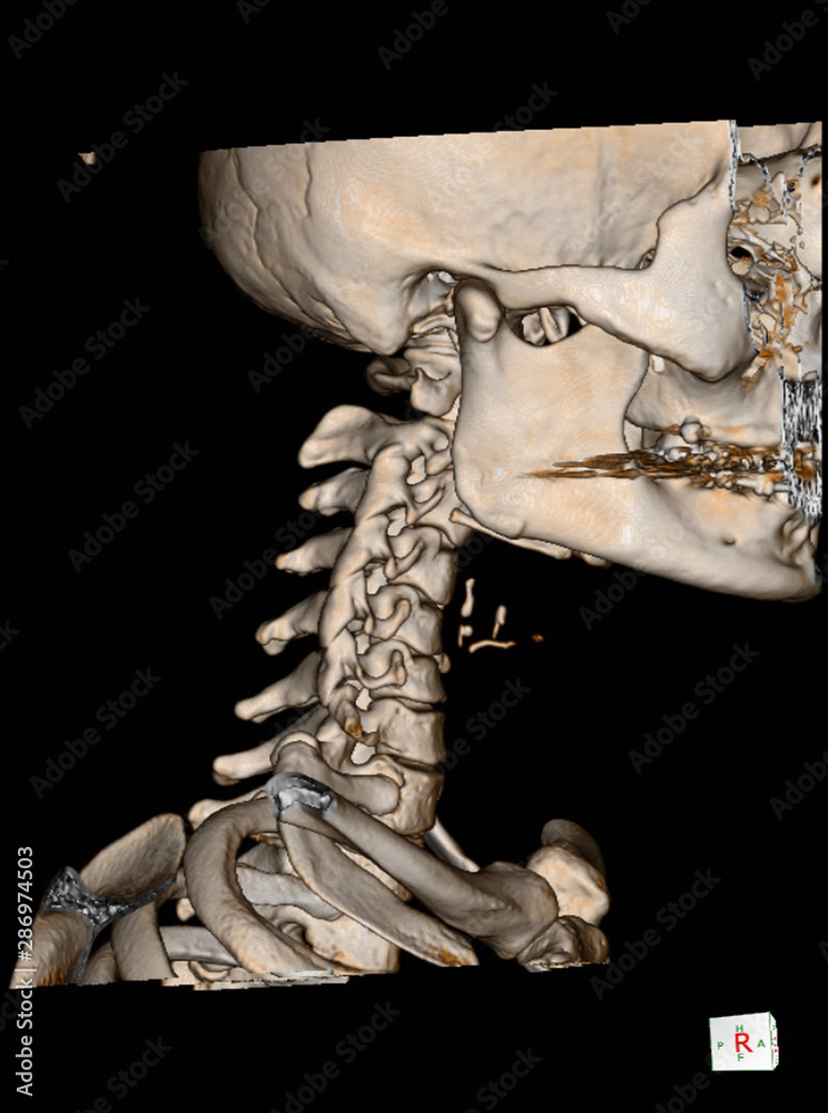 CT Scan cervical spine 3 D render and Xray Cspine finding Reverse