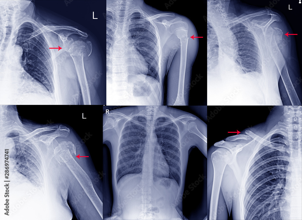Collection Film x ray shoulder radiograph show shoulder dislocation and