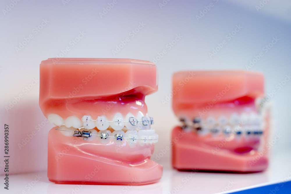 Two dental casts with braces on them on white background Two dental casts with braces on them on white background