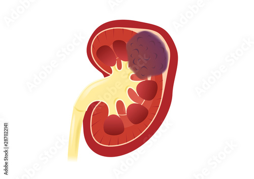 kidney cell cancer vector