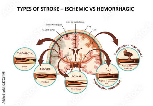 Types of stroke – ischemic vs hemorrhagic photo