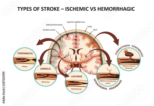 Types of stroke – ischemic vs hemorrhagic