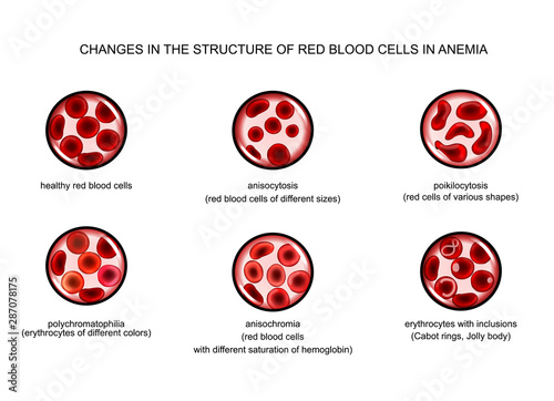 red blood cells in various anemias
