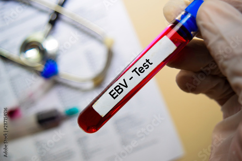 EBV - Test with blood sample. Top view isolated on office desk. Healthcare/Medical concept photo