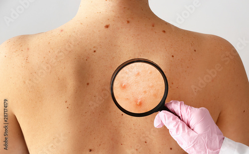 Dermatologist examining moles of patient in clinic