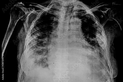 Chest X-Ray of a male patient with right pleural effusion and pneumonia photo