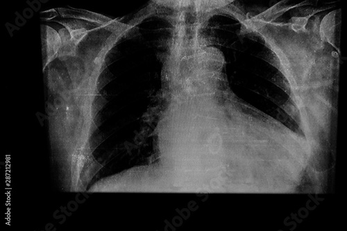 Chest X-ray in a patient with heart enlargement due to congestive heart failure photo