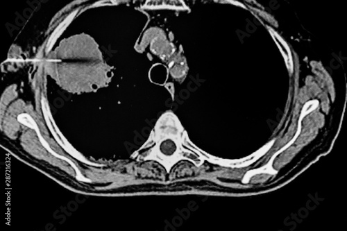 CAT - Scan of Transthoracic fine needle aspiration in a patient with a lung tumor photo
