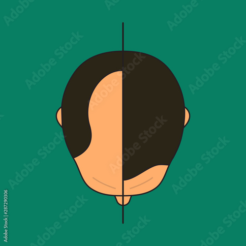 male alopecia, plastic surgery