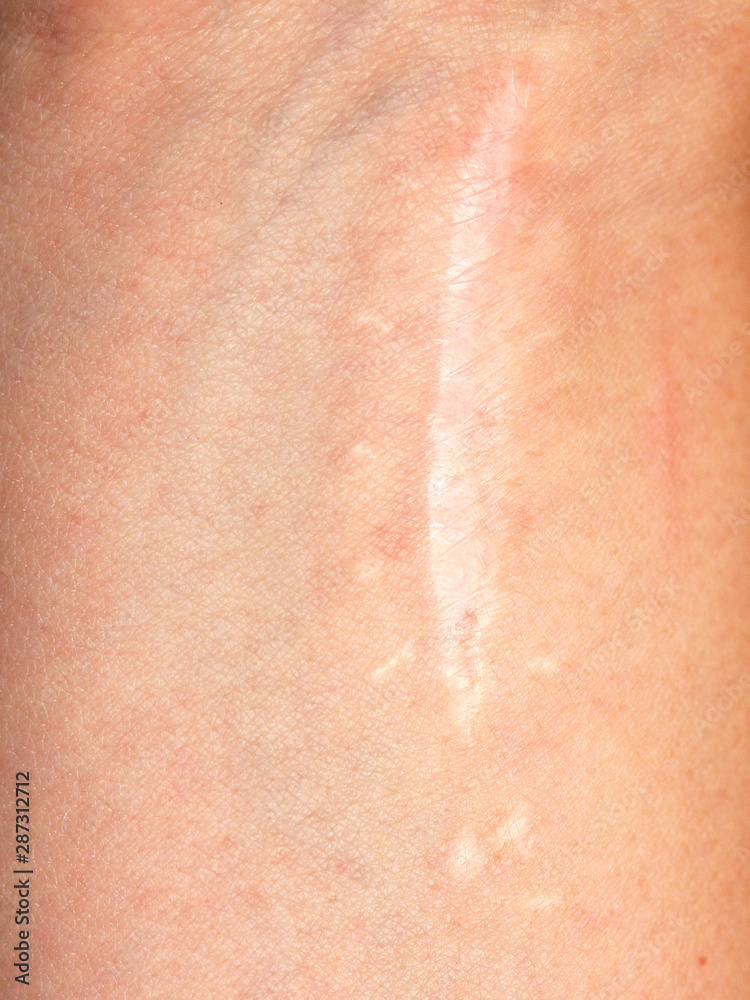 Close-up of arm with old scar,  scars, surgical scar on the skin