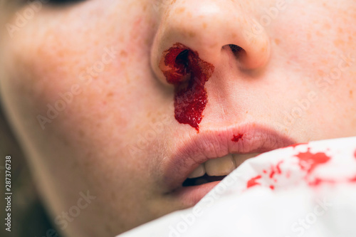 Wound nosebleed, woman bleeding from her nose, nose injury blood and tissue photo