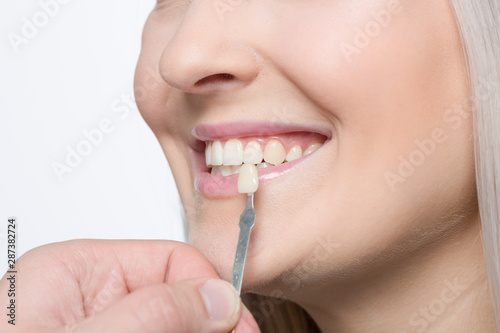 Using shade guide at mouth to check veneer of teeth for bleaching