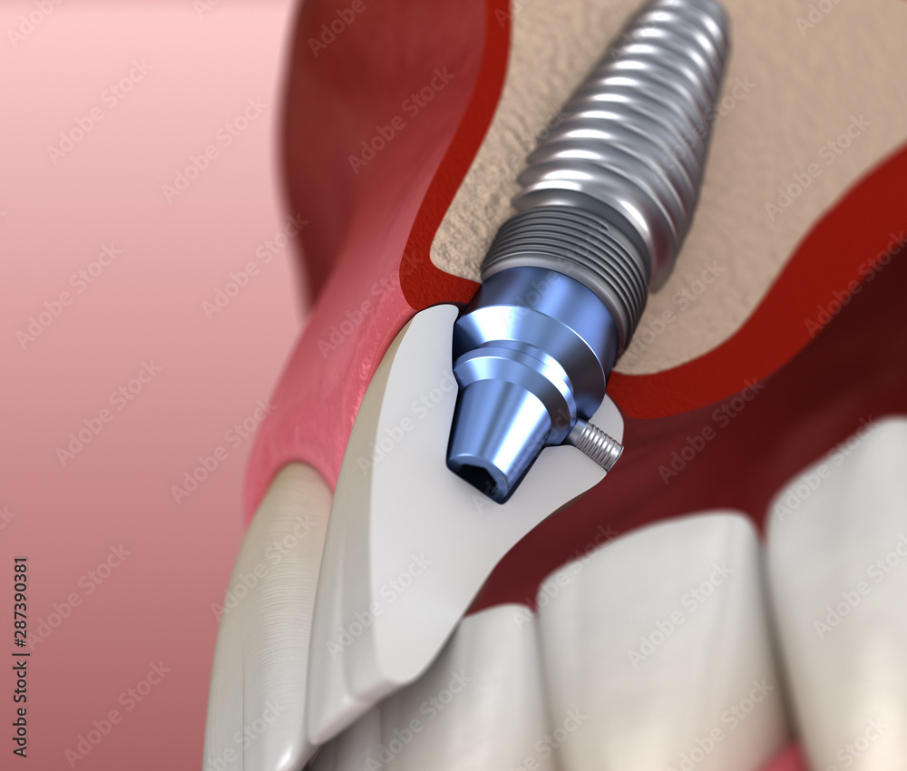 central-incisor-recovery-by-implant-medically-accurate-3d-illustration