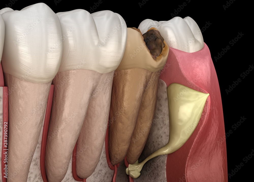 Periostitis tooth Lump on Gum Above Tooth. Medically accurate dental