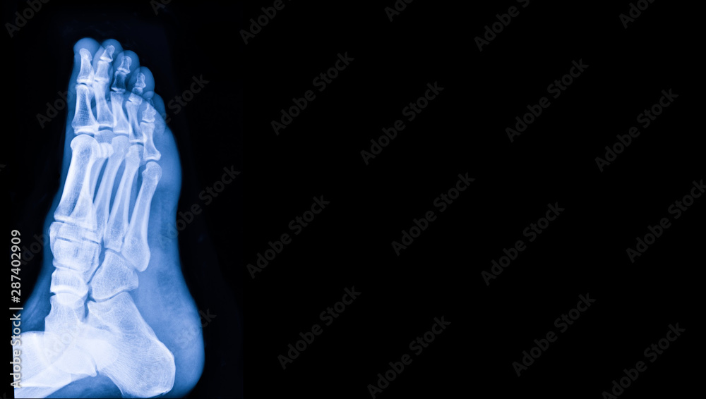 X-ray image of foot with copy space. Medical and health care concept. X-ray image of foot with copy space. Medical and health care concept.