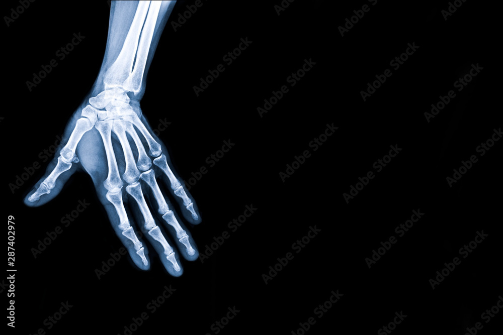 X-ray image of hand with copy space for text. X-ray image of hand with copy space for text.