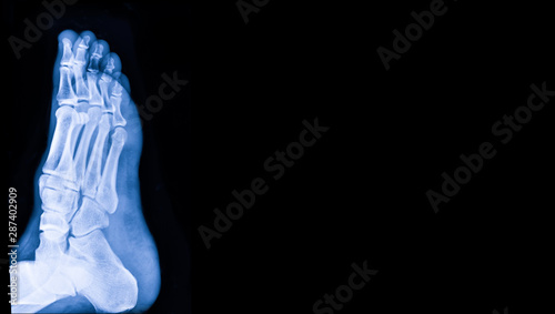 X-ray image of foot with copy space. Medical and health care concept.