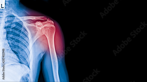X-ray image of shoulder pain, shoulder ligament tendinitis, shoulder muscle strain.